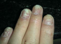 治疗灰指甲方法