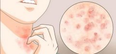 <b>如何预防湿疹</b>