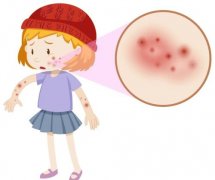 <b>厦门湿疹早期的症状有哪些</b>